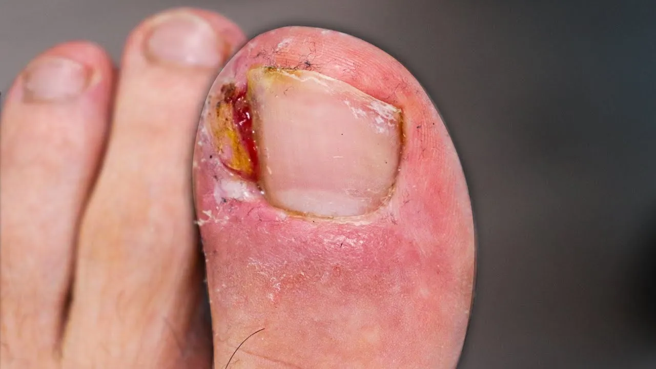 Removing his meaty ingrown toenail
