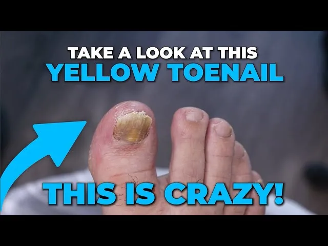Could this toenail be damaged enough to be removed?