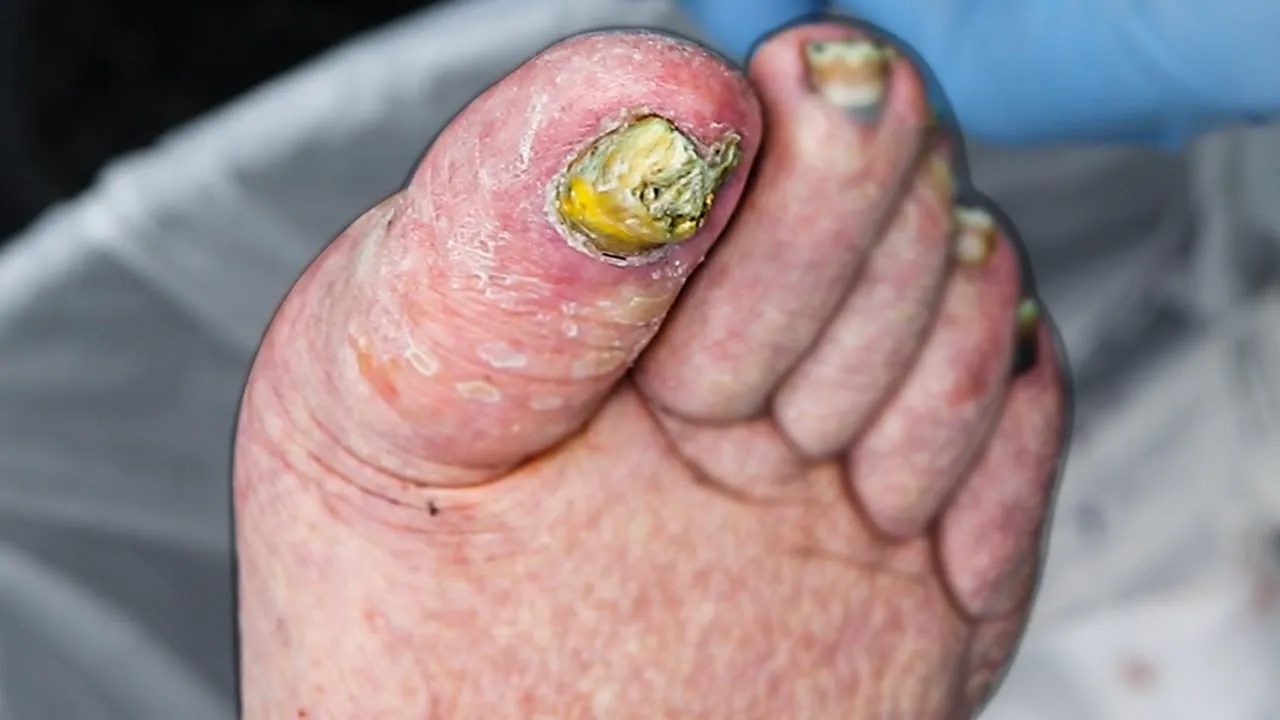 Gnarly toenail removal Healing a damaged fungal foot