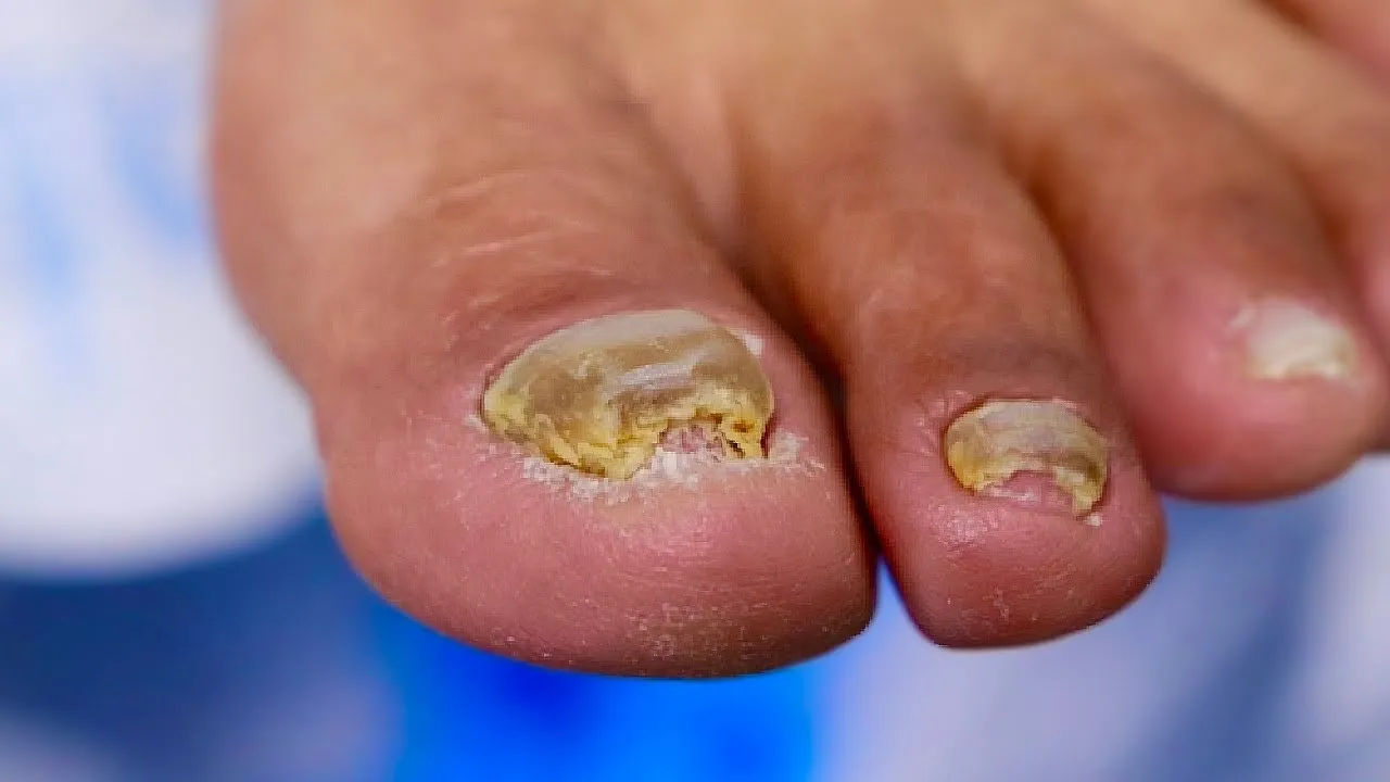 Thick, damaged fungal toenail not getting better!!! why?!?!