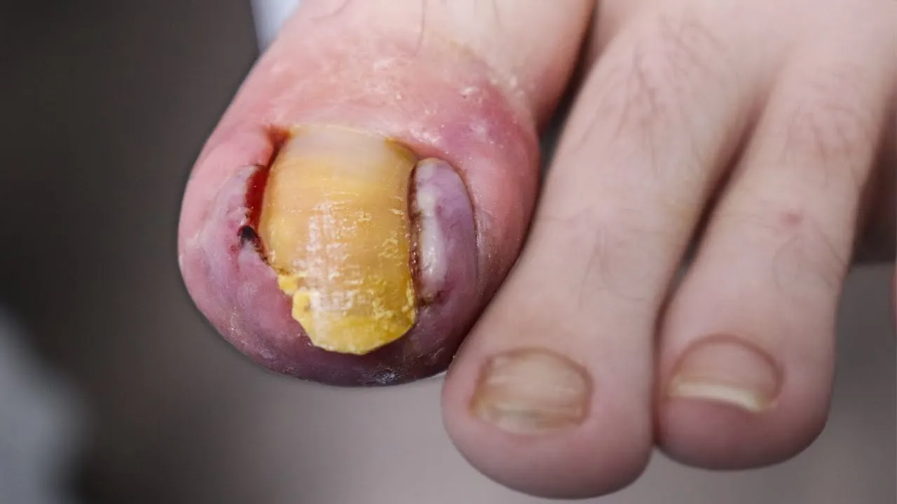 Removing an unbelievable infected ingrown toenail!!!