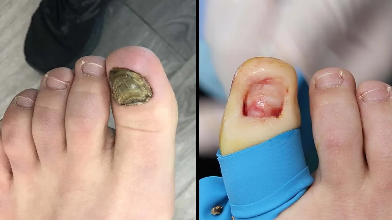 Stubborn ingrown toenail removal Fixing 4 failed ingrown nail surgeries