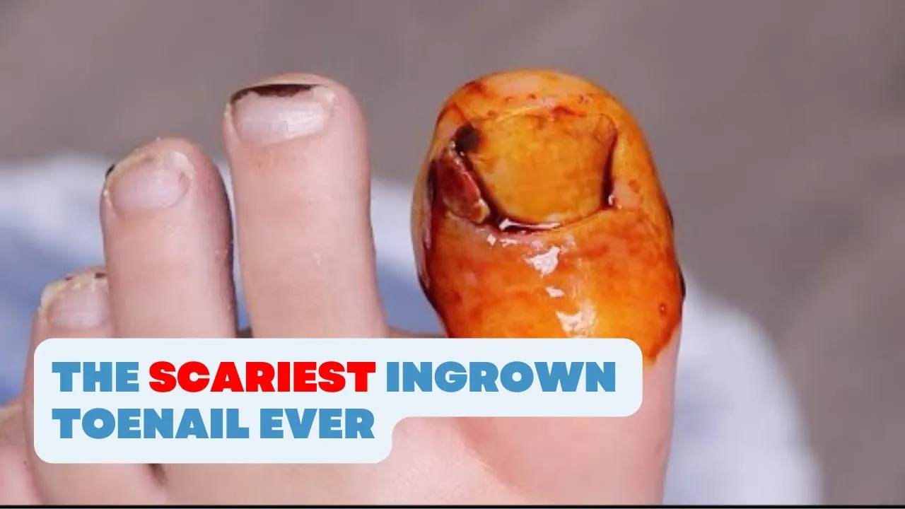 Take a guess on what caused this massive ingrow