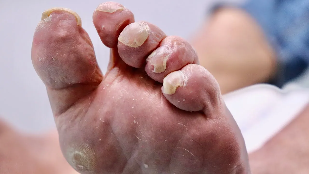 Trimming curled toenails & removing dead hard skin