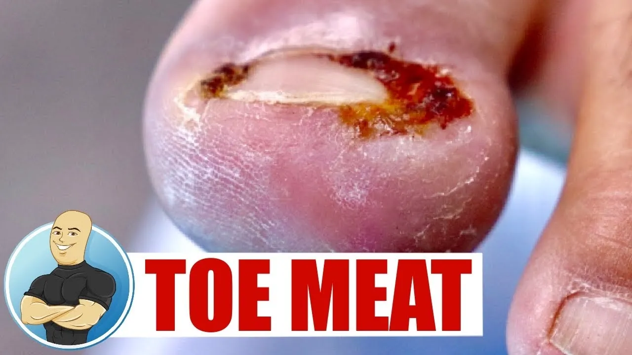 Huge toe meat ingrown nail removal ***thick & juicy ***
