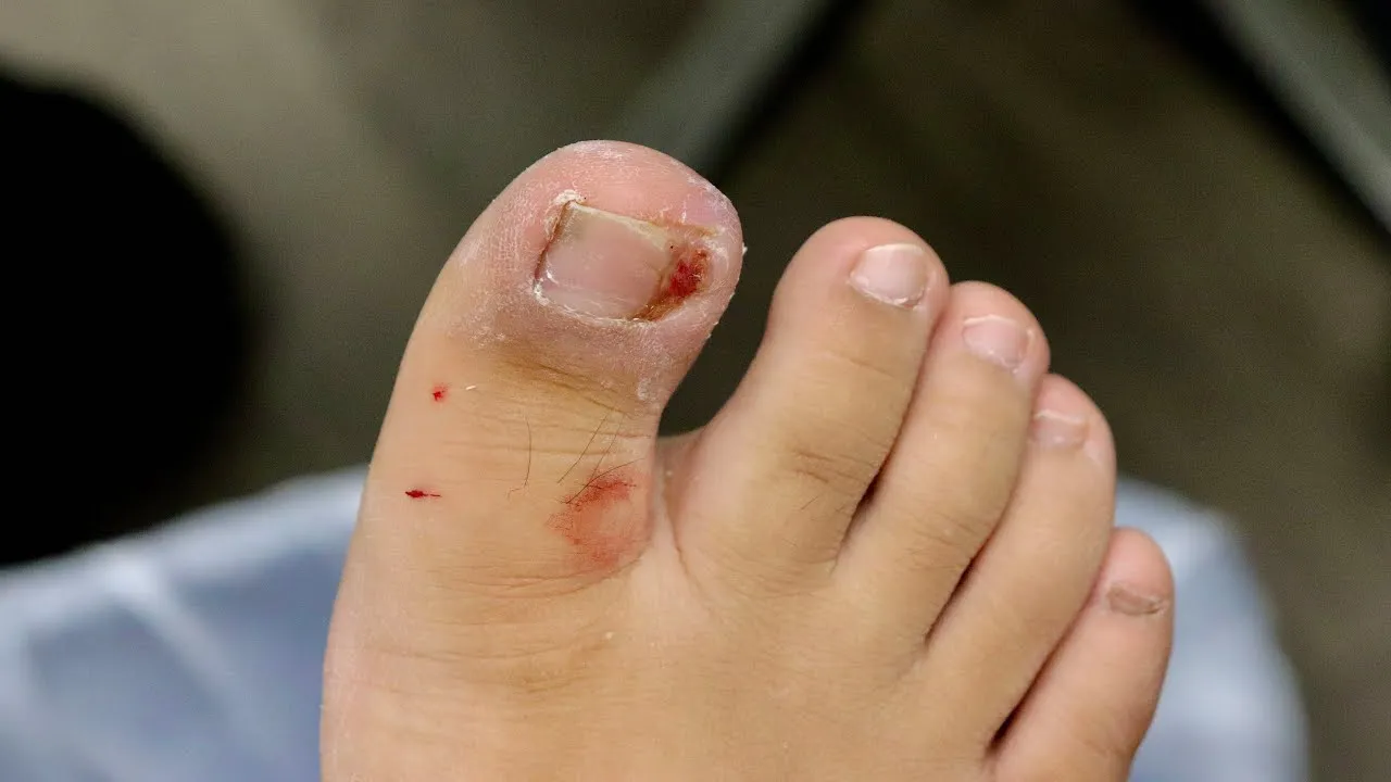 Treating a painful, infected ingrown toenail