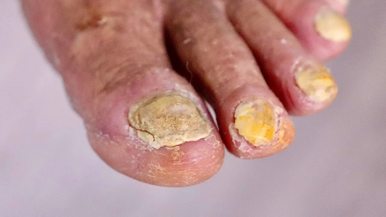 Super high risk thick toenail trimming pt.2