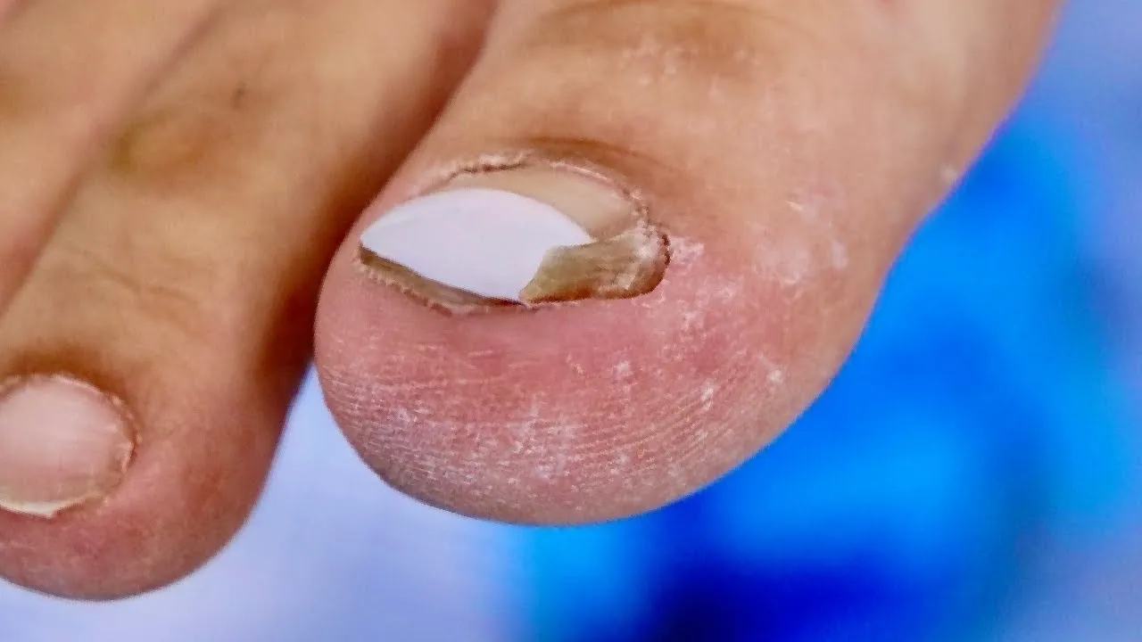 Biggest ingrown toenail spike ever??? ***failed ingrown surgery***