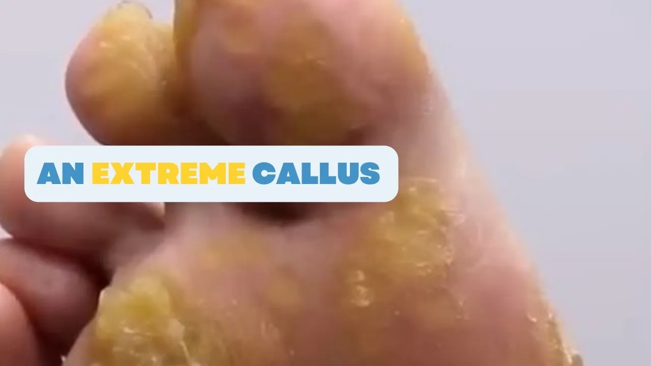 What causes an extreme callous like this