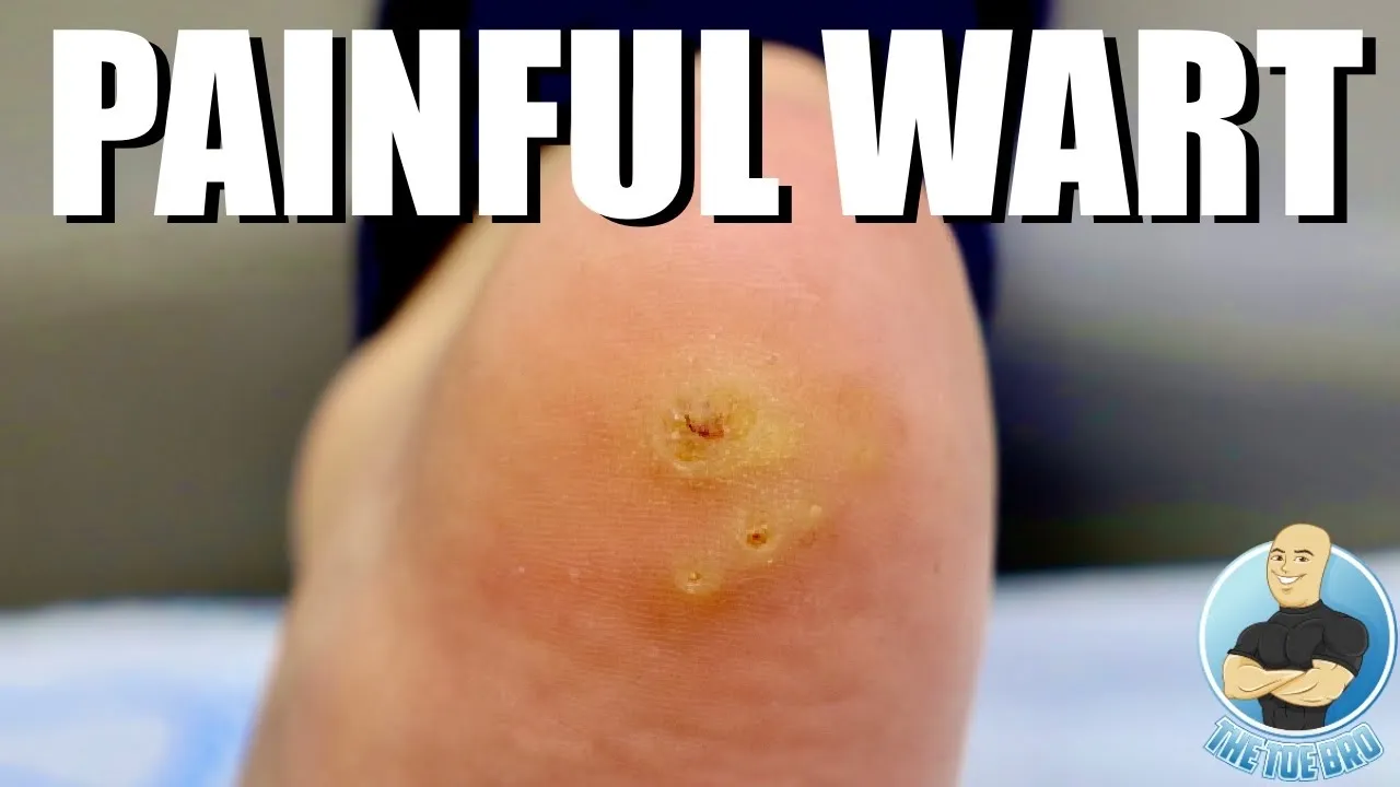 8-Year-Old Girl BRAVES a Painful Wart Removal 😮🔥 