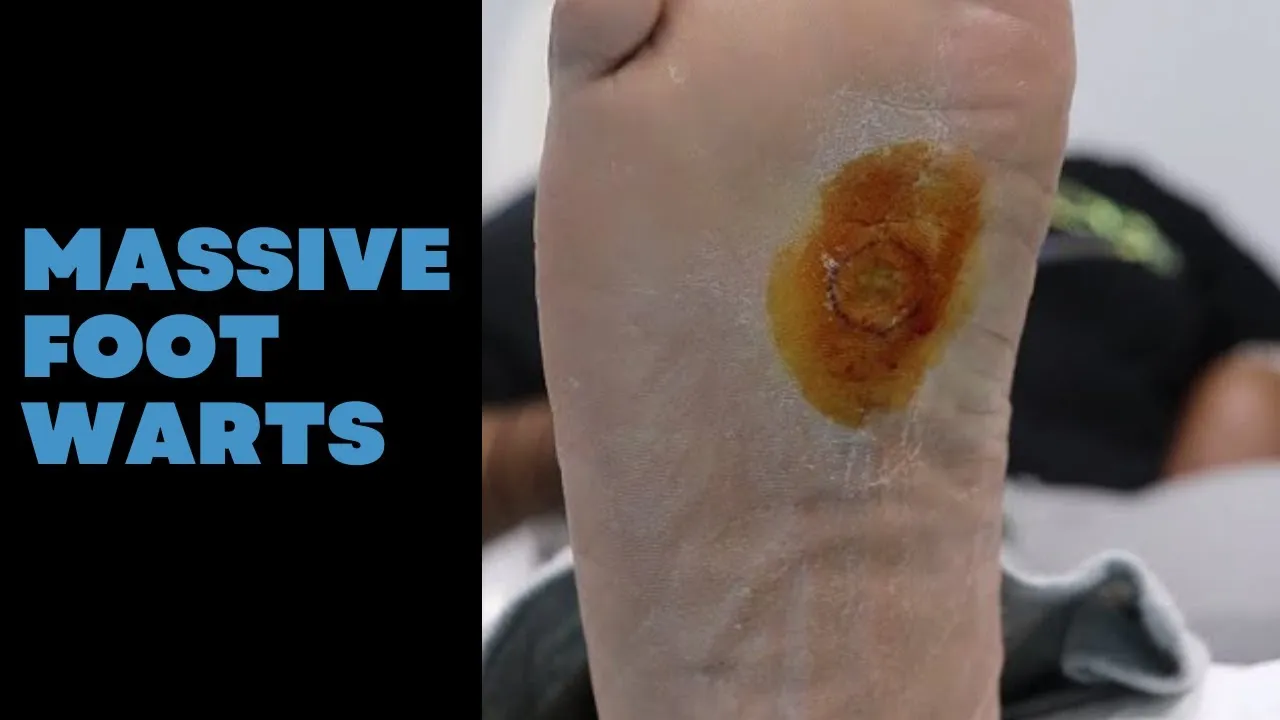 She Had This Wart for 7 YEARS! 😱 MASSIVE Plantar Wart Removal