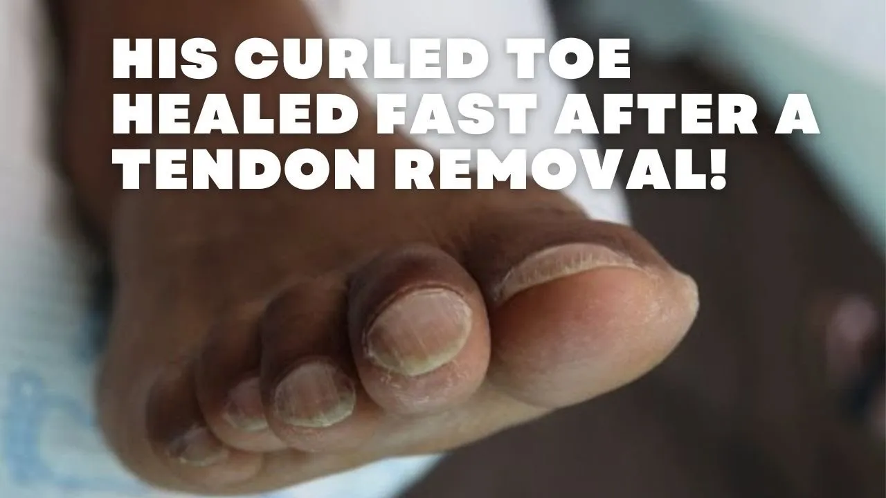 Tendon Removed to Fix a Curled Toe! 😳 Incredible Recovery Results