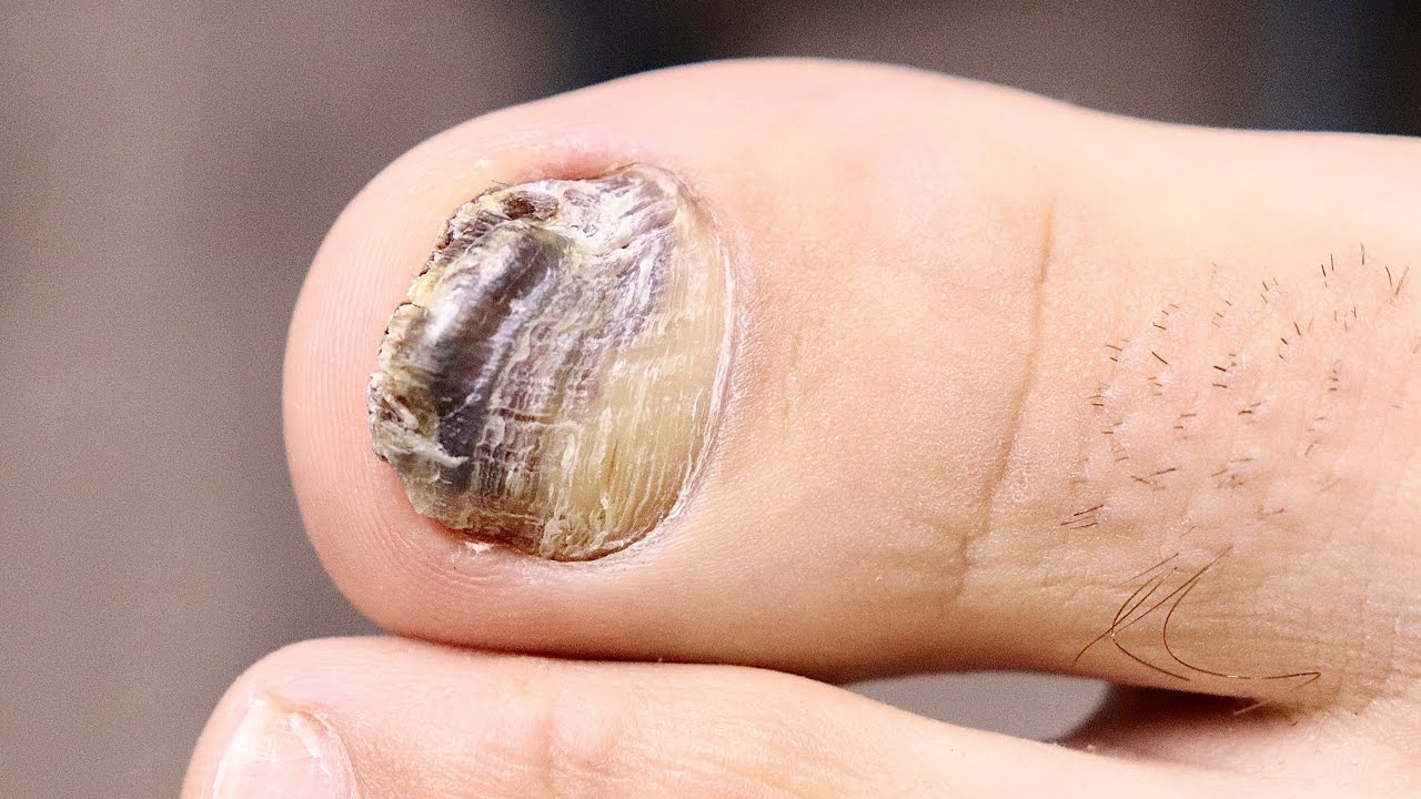 Why Are These Toenails Super Thick and Discolored?! 🦶🟤