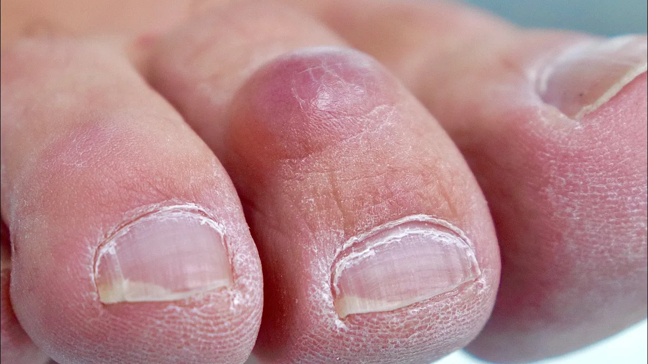 Popping a Painful Toe Cyst – Watch the Fluid Release!