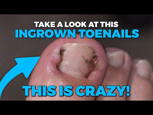 The skins on his toenail got inflamed because of this ingrown