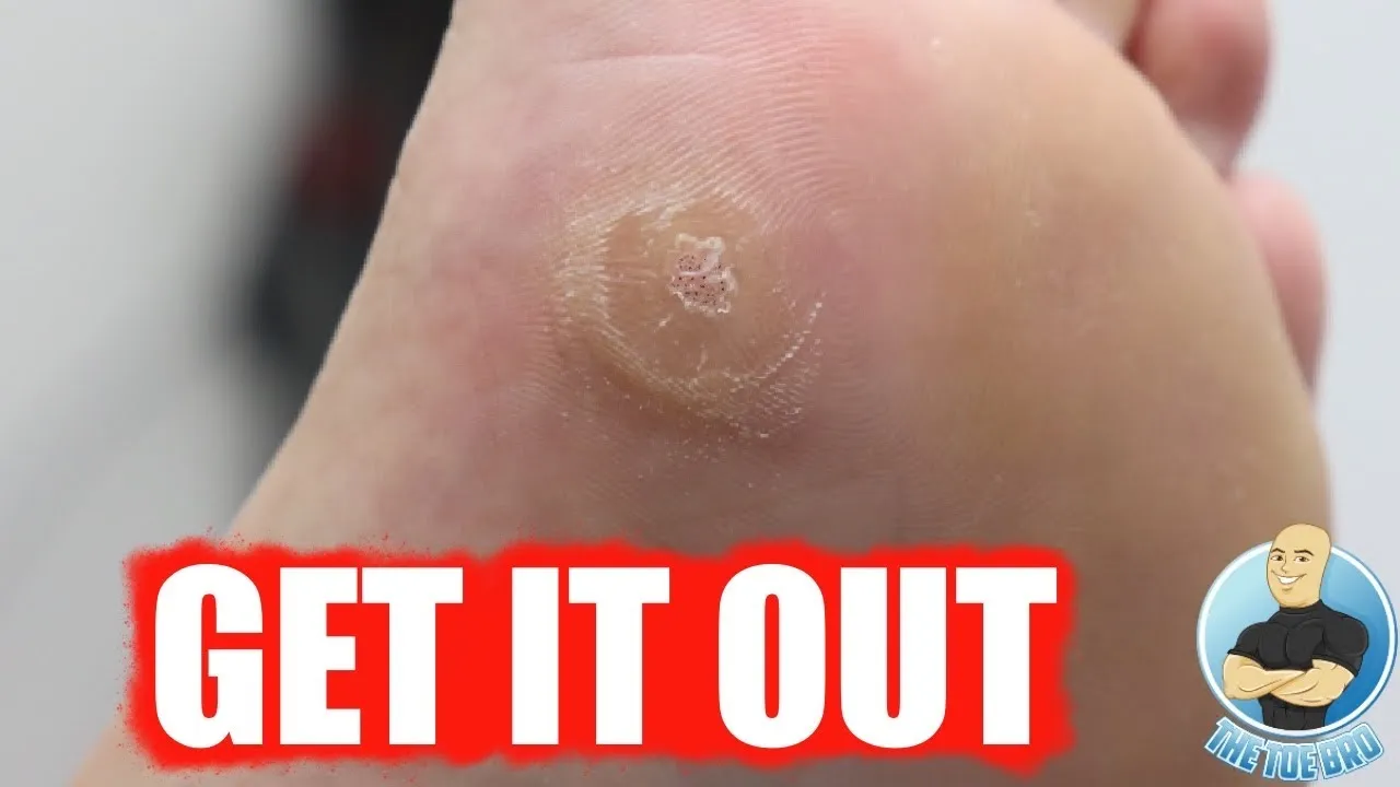 She waited 2 years to cut this wart out!!!