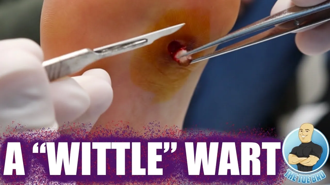 Scooping out a kid’s stubborn foot wart