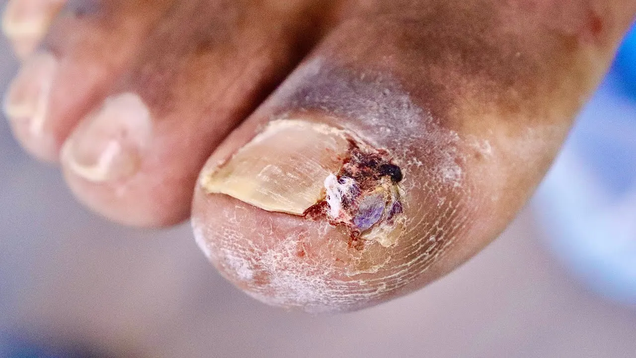 His last surgery failed....juicy infected ingrown toenail