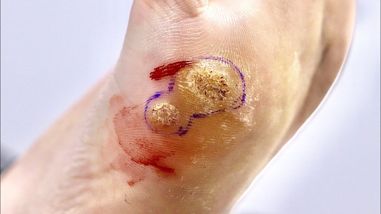 Huuugggeee double wart surgical removal 💥🦶