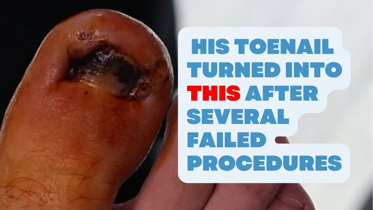 After several failed procedures his toenail turned into this