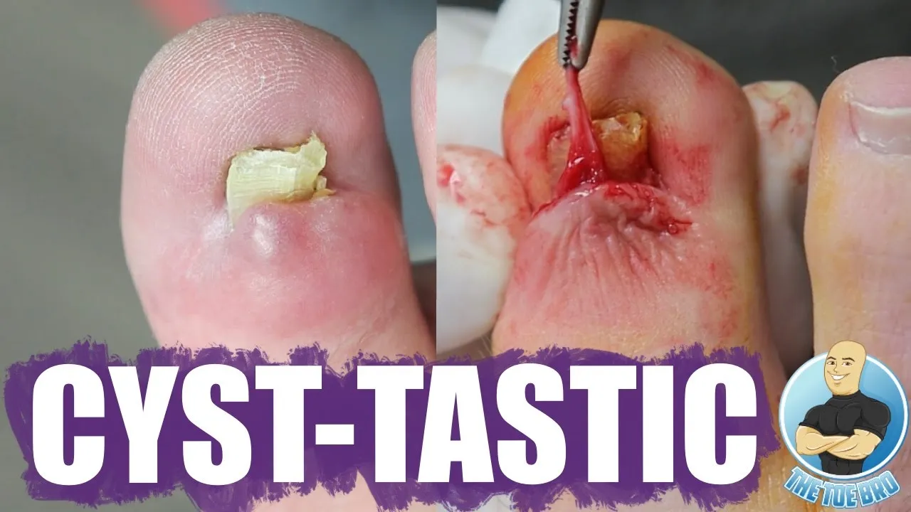 He fainted while i popped his huge toe cyst