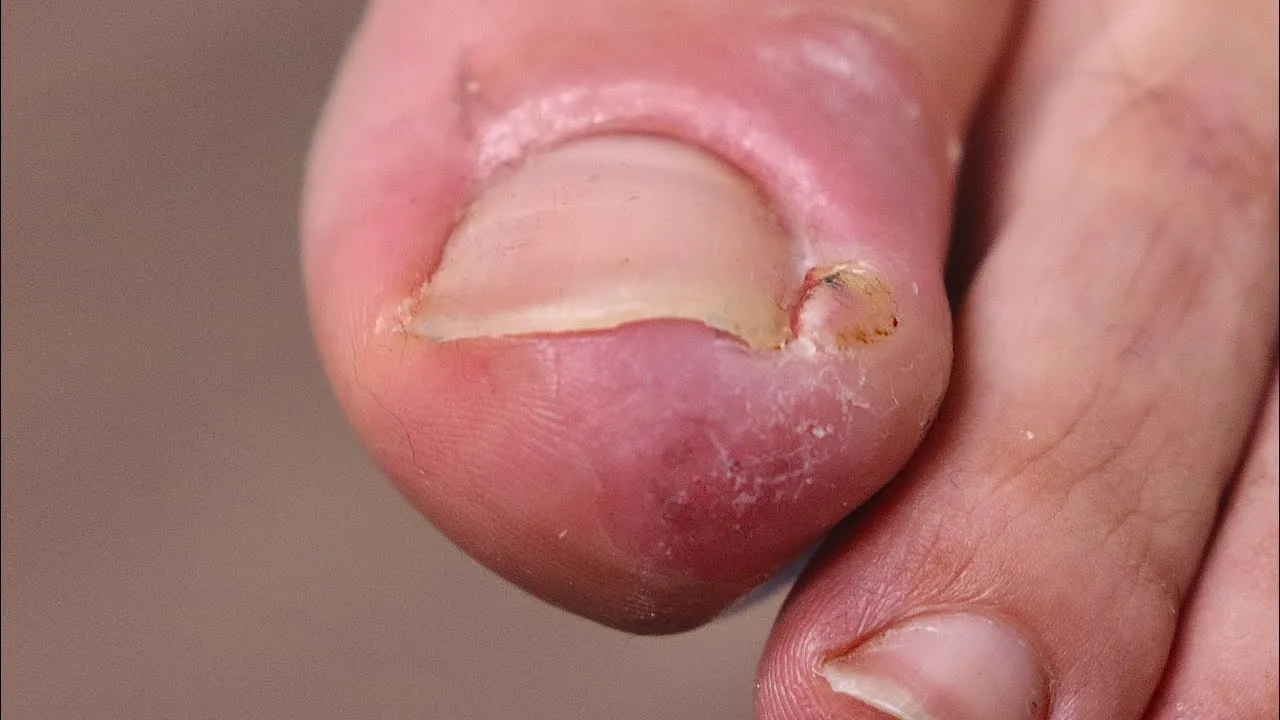 He tried cutting out his juicy ingrown toenail ***fail???***