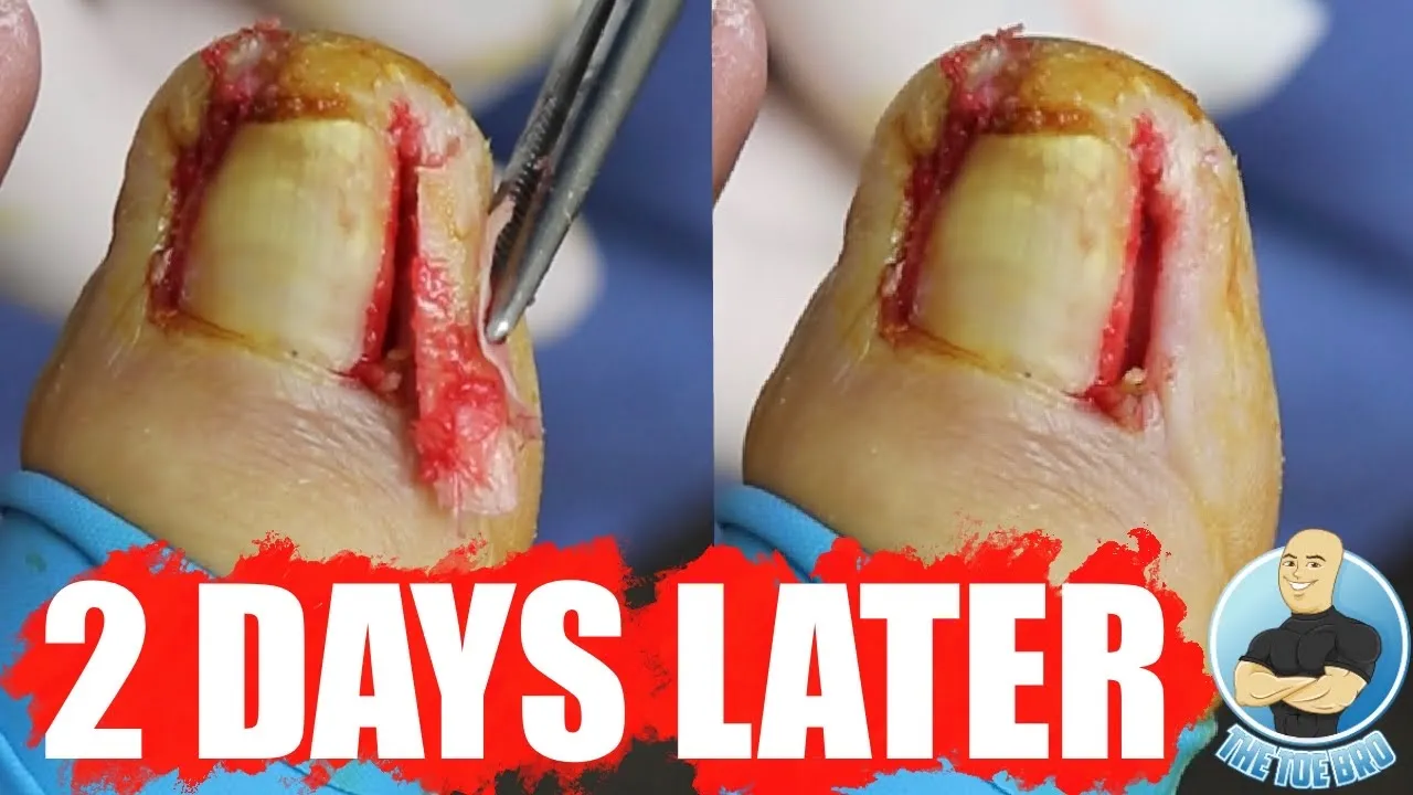 Aftermath of ingrown toenail surgery ***2 day follow-up***