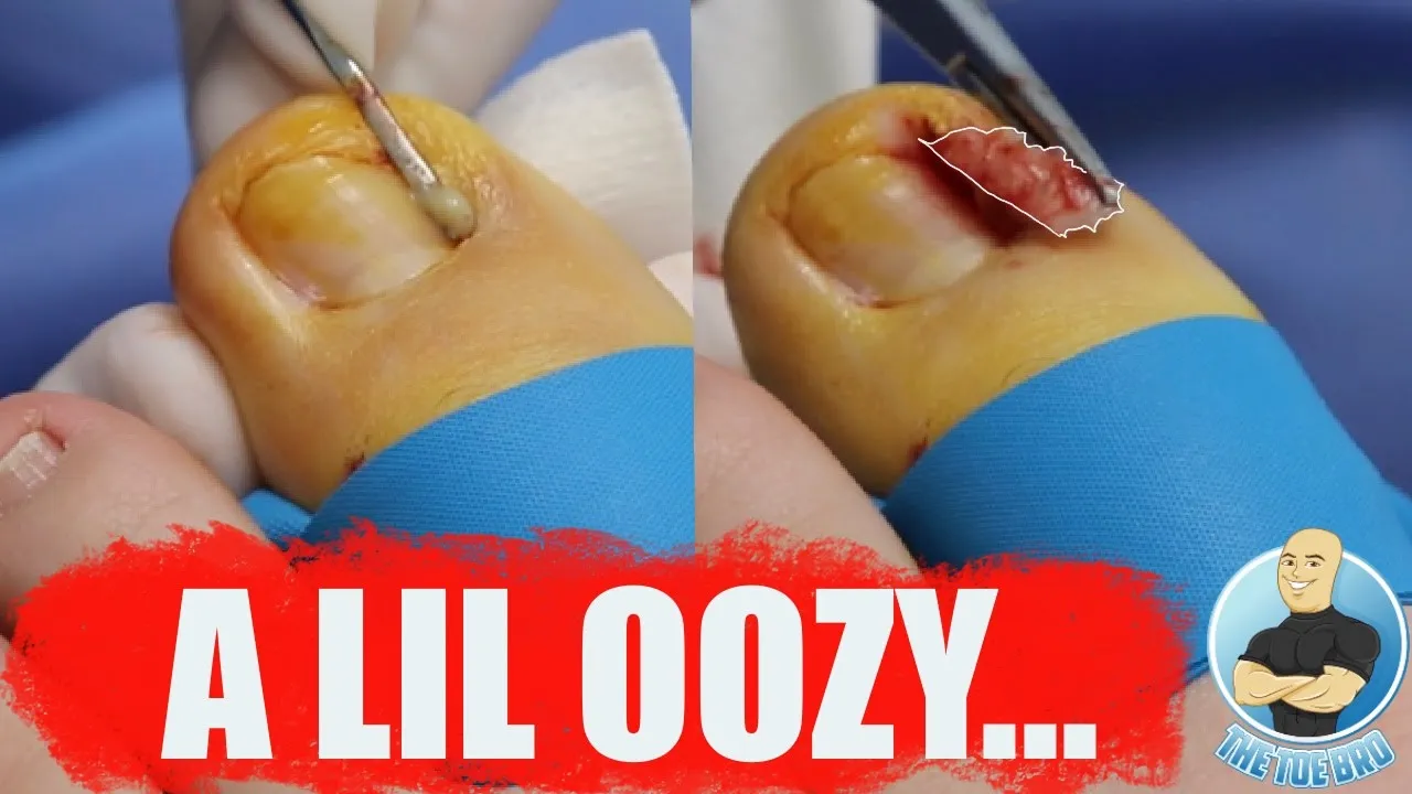 He keeps getting infected ingrown toenails so today we remove them forever!!!