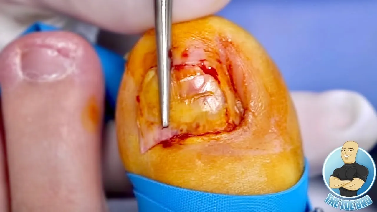 Fixing stubborn painful ingrown toenail surgery!!!