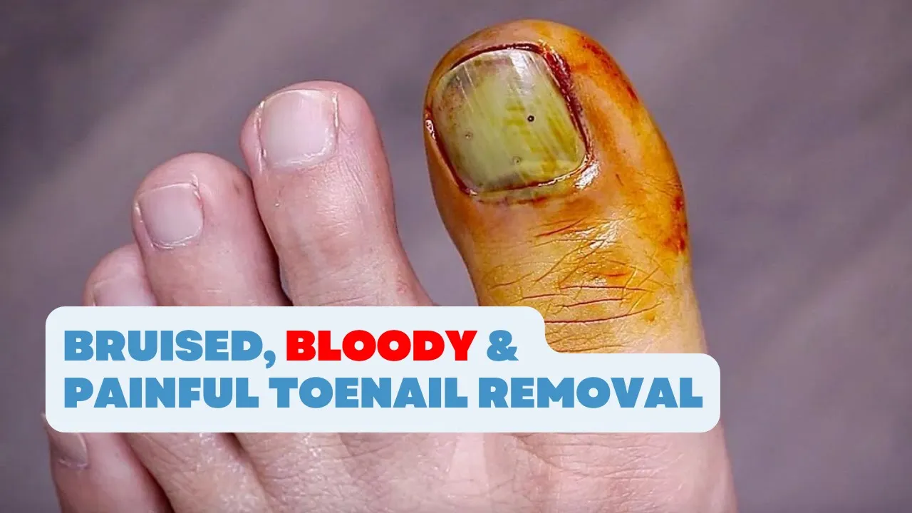 Bruised, bloody & painful toenail removal