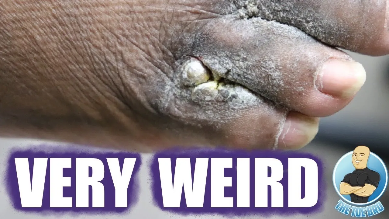 Weird growth in between toes ***abnormal skin growth***