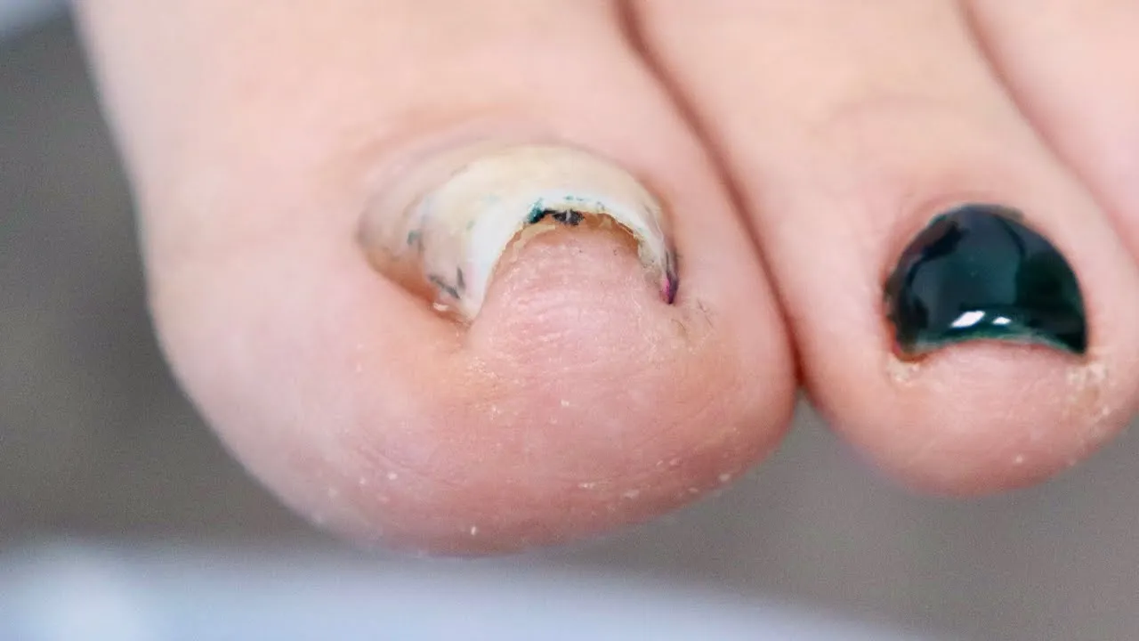 Super curved ingrown toenail plus nail removal!!!!