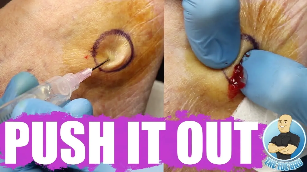 Squeezing a huge foot bump!!! ***super satisfying***