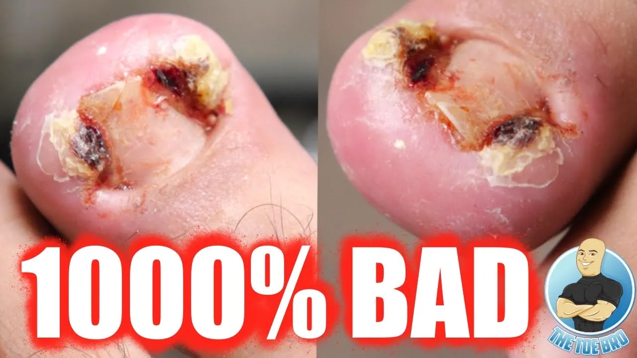 Insane overgrown infected toenail removal