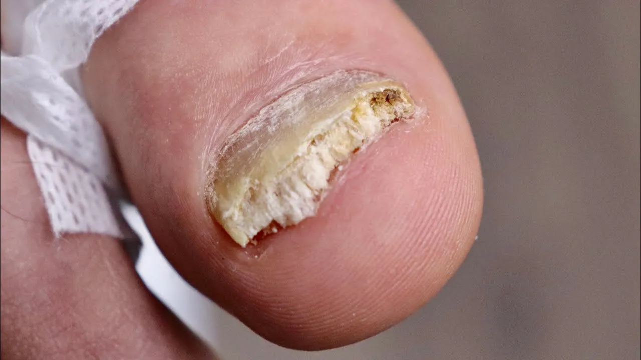 Bye bye bye damaged fungal toenail removal