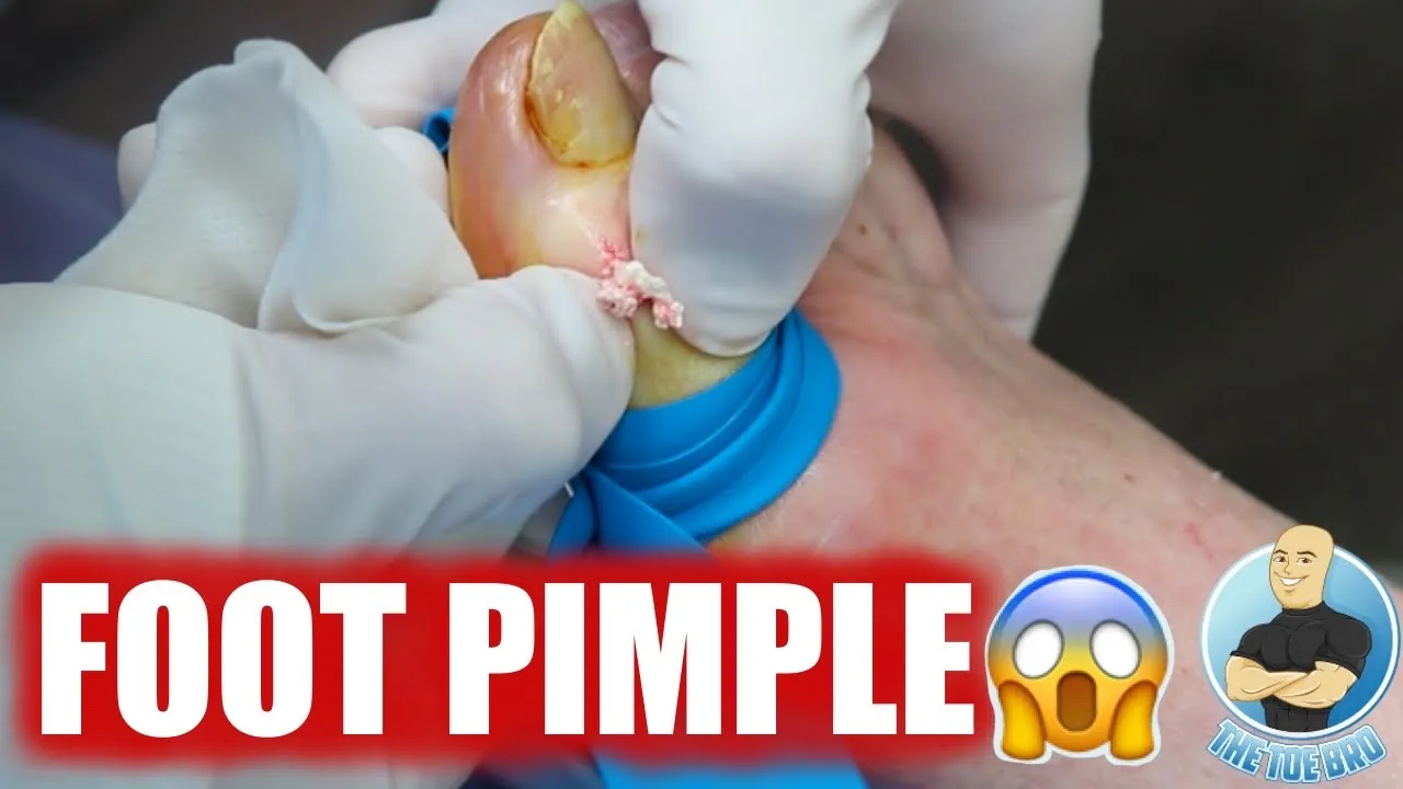 Popping a huge bump on a big toe!!! ***warning: super explosive***