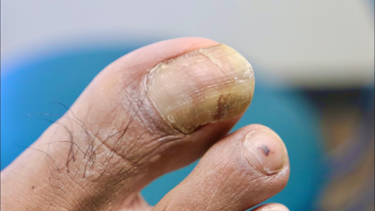 Is this toenail fungus or a damaged toenail?!