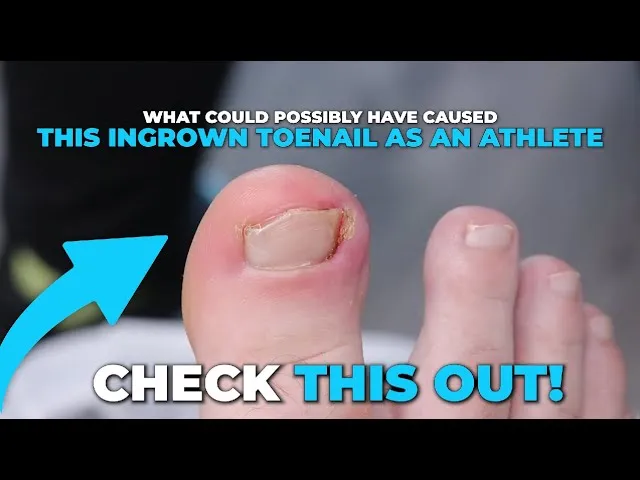 Sports leaves trauma to your toes! (massive ingrown toenail)