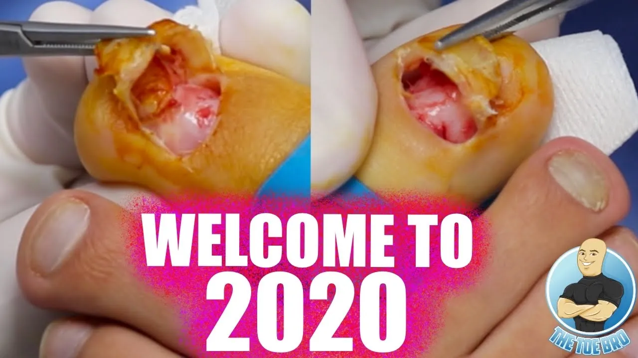 Double damaged toenail removal in the year 2020