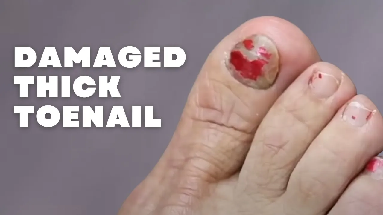 What could prevent this to keep happening?! ***damaged thick toenail***