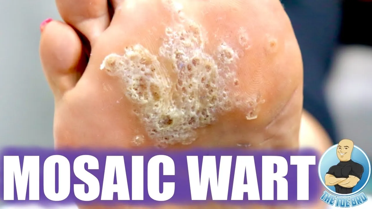 Using a microwave to kill a wart?! ***no creams no freezing no surgery***