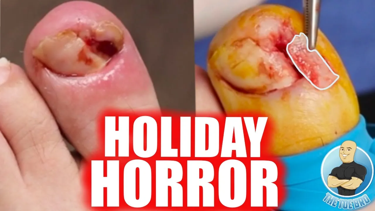 Unwrapping a super overgrown ingrown toenail for christmas!!!