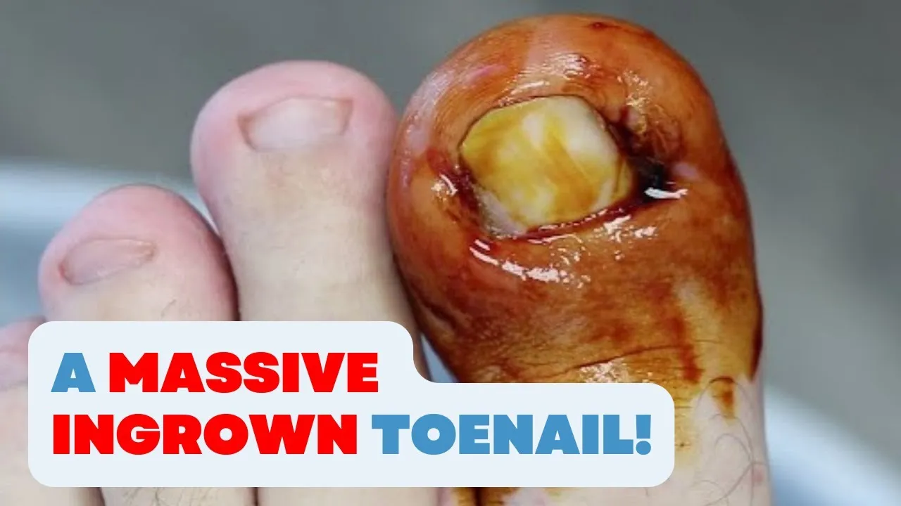 What caused this [massive] ingrown toenail?!!