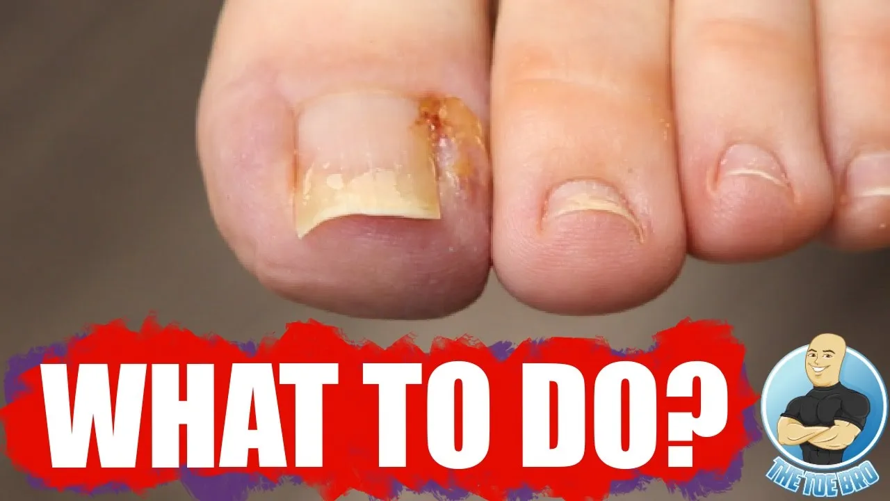 You have an ingrown toenail...now what?! ***part 1***