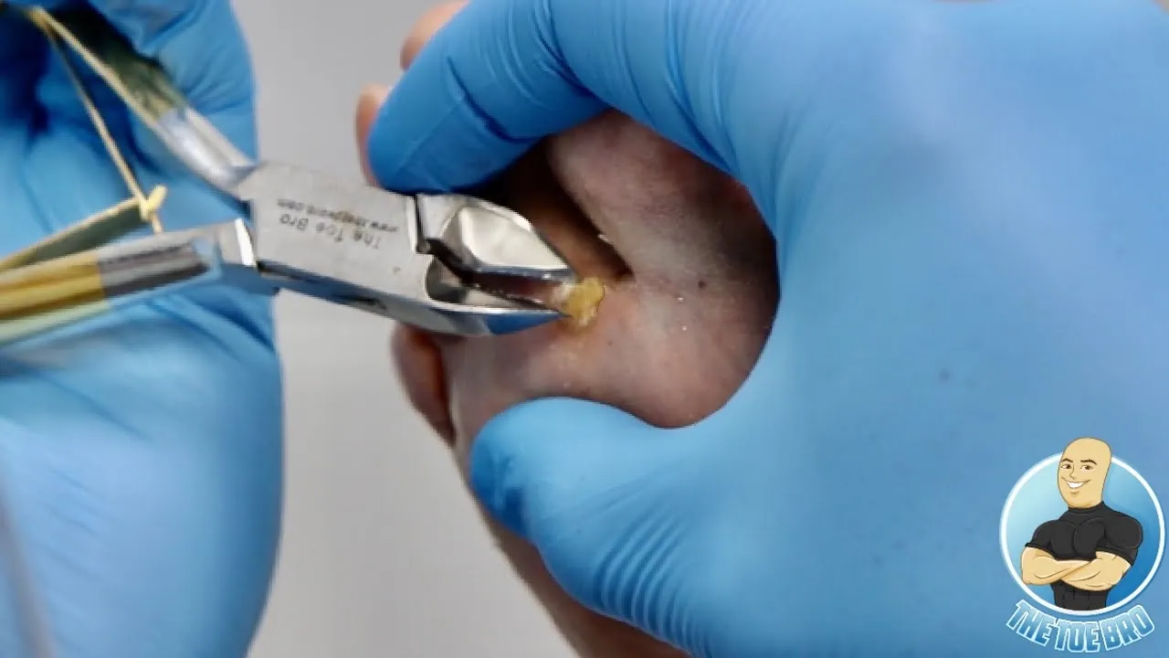 Skin horn removal on high risk diabetic patient!!!