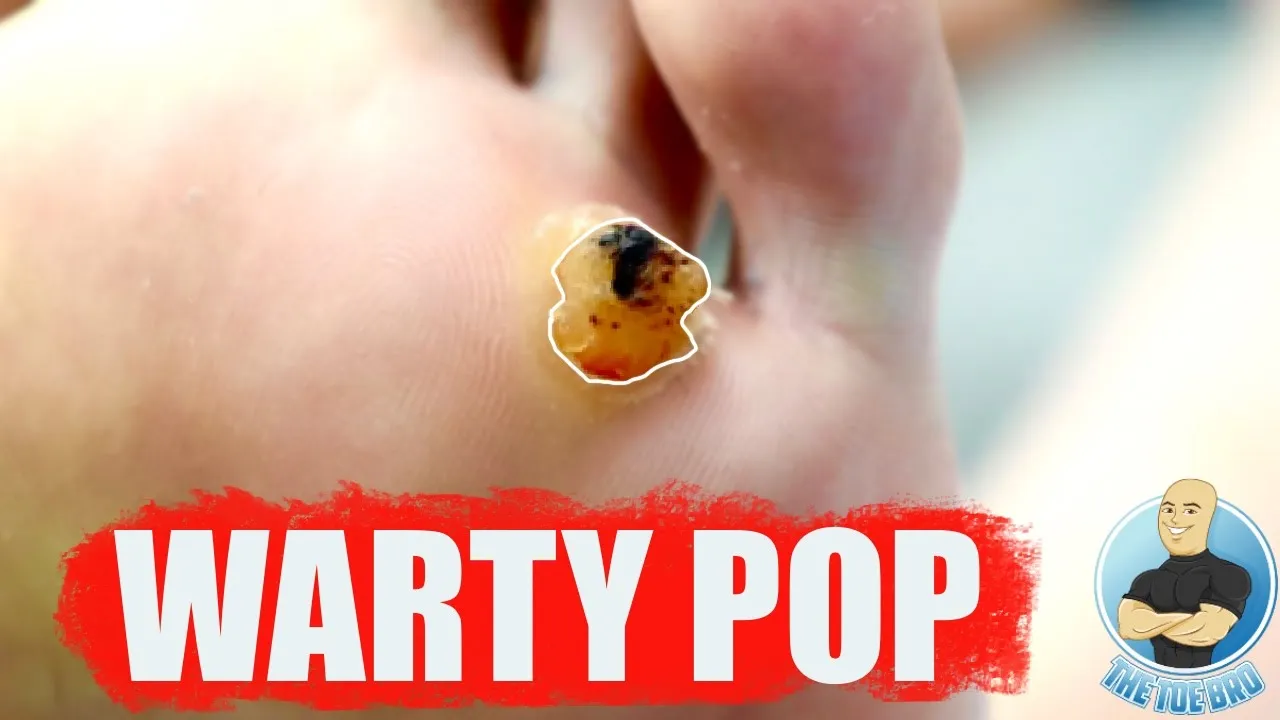 Large painful puffy foot wart gets “popped” ***surgical wart removal***