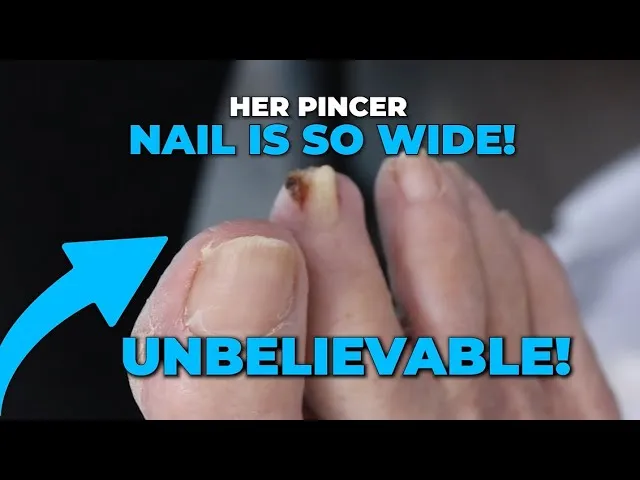 What causes pincer toenail??