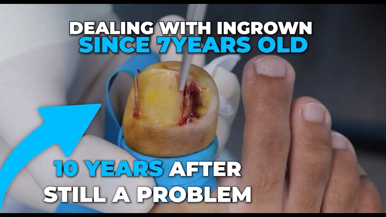 Unhealed ingrown since seven years old, what could happen?