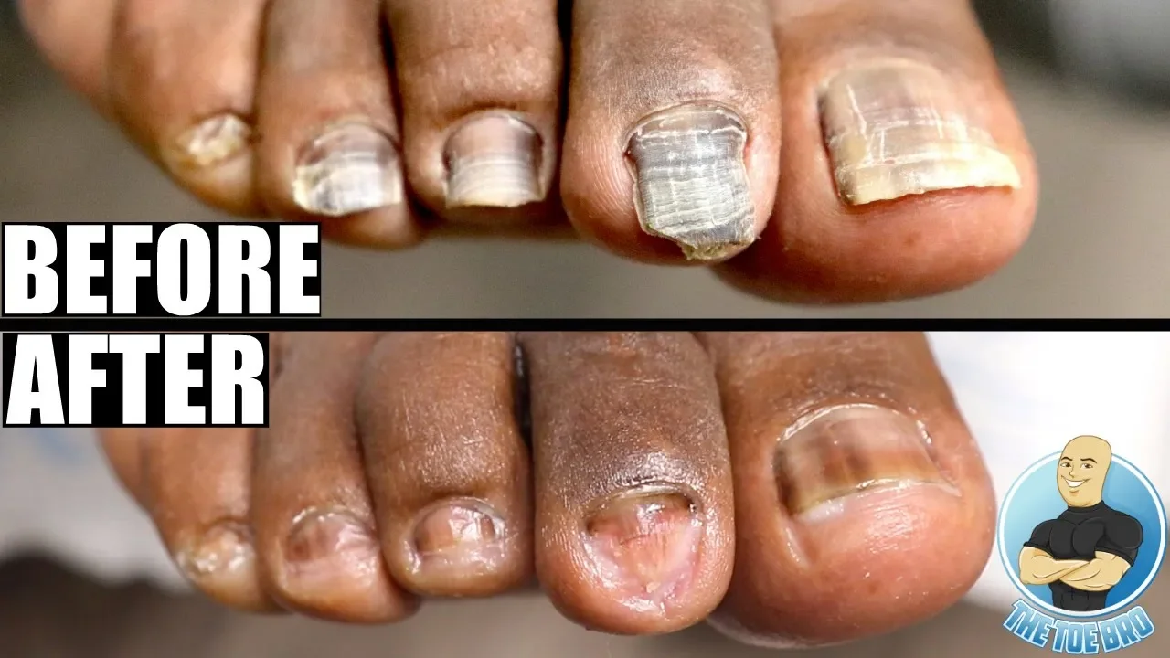 Toenail glow up transformation ***from bad to beautiful toenails***