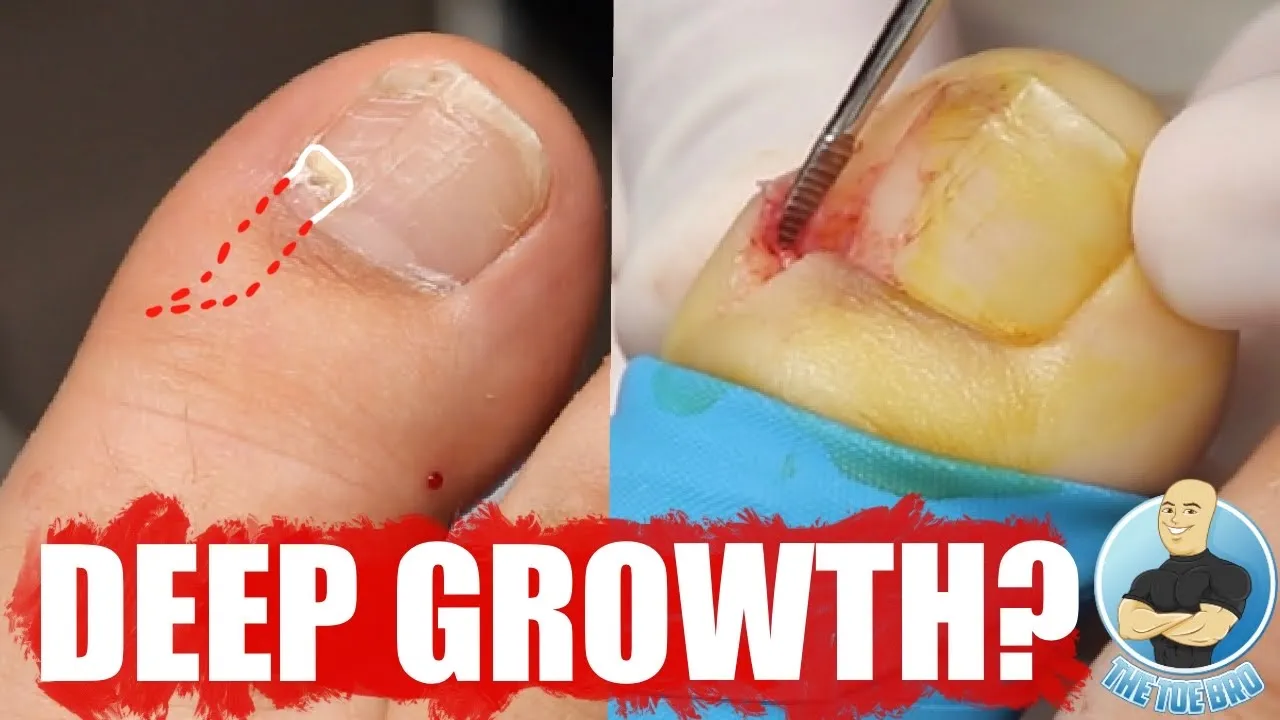 Removing a nail tumor from a young girl’s toe!!! ***graphic surgery***